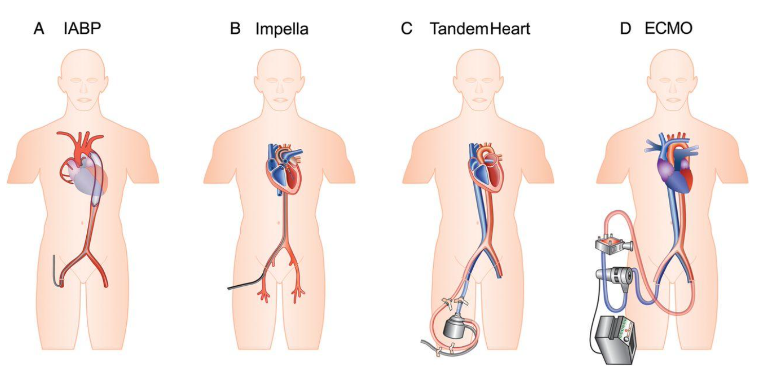 Courtesy of Ouweneel, D. M., Claessen, B. E., Sjauw, K. D., & Henriques, J. P. (2015). The Role of Percutaneous Haemodynamic Support in High-risk Percutaneous Coronary Intervention and Cardiogenic Shock. Interventional cardiology (London, England), 10(1), 39–44. https://doi.org/10.15420/icr.2015.10.1.39