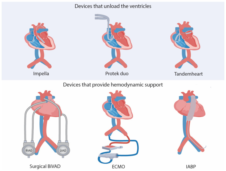 Illustration of Ventricular Assist Devices. Courtesy of Abdul-Rahman T, Lizano-Jubert I, Garg N, Tejerina-Marion E, Awais Bukhari SM, Luisa Ek A, Wireko AA, Mares AC, Sikora V, Gupta R. The Use of Cardioprotective Devices and Strategies in Patients Undergoing Percutaneous Procedures and Cardiac Surgery. Healthcare (Basel). 2023 Apr 11;11(8):1094. doi: 10.3390/healthcare11081094. PMID: 37107928; PMCID: PMC10137626.